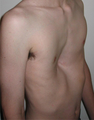 File:Pectus1.jpg