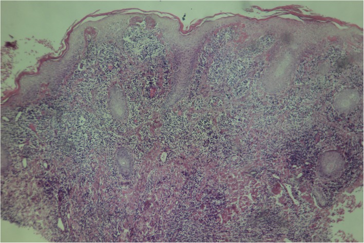 File:Psoriasiform epidermal hyperplasia and band-like lymphocytic infiltrates in papillary dermis.jpg