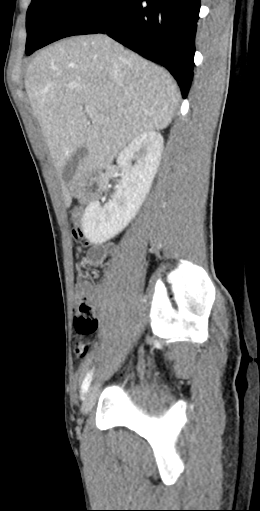 CT of a normal abdomen and pelvis, sagittal plane 62.png