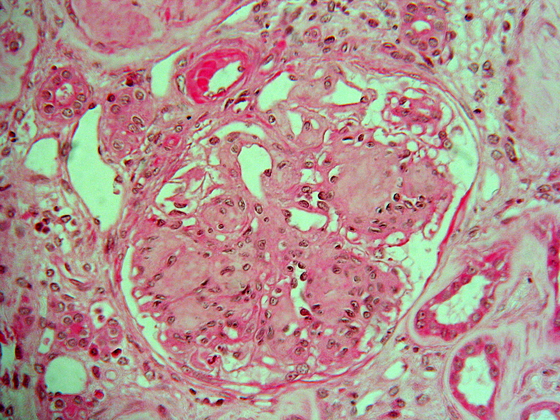 File:Diabetic nephropathy.jpg