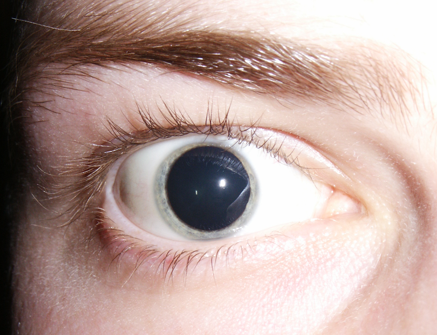 What Causes Dilated Pupils In A Child