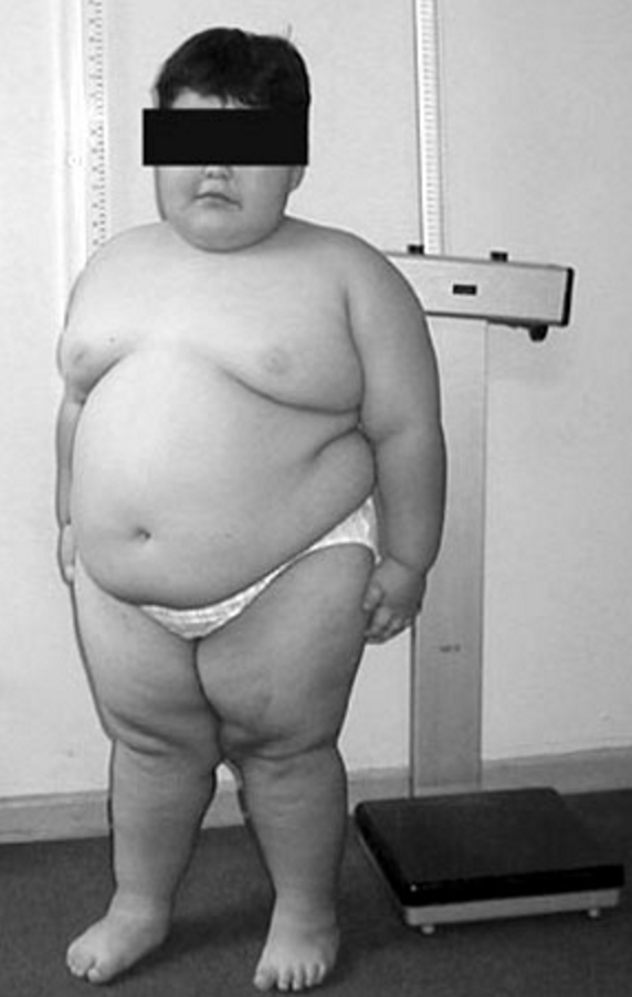 Prader–Willi syndrome - Wikipedia