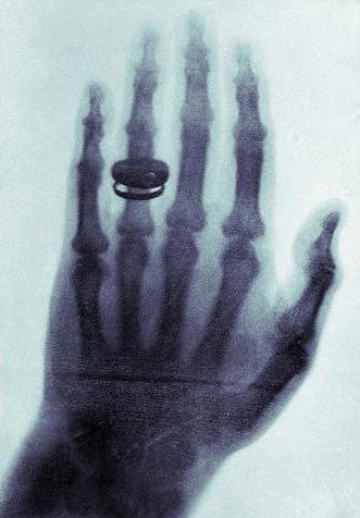 File:X-ray by Wilhelm Röntgen of Albert von Kölliker's hand - 18960123-01.jpg