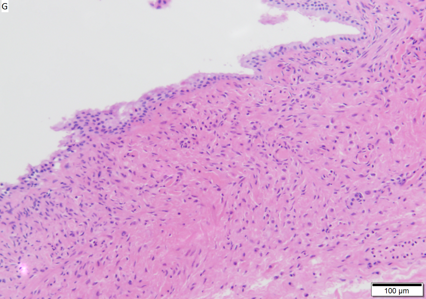 Mucinous cystic neoplasm of pancreas