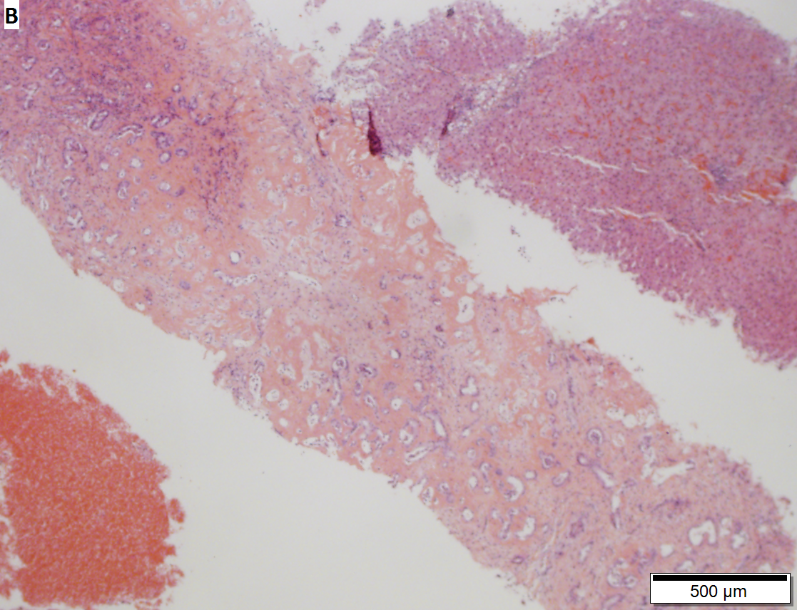 Bile duct adenoma