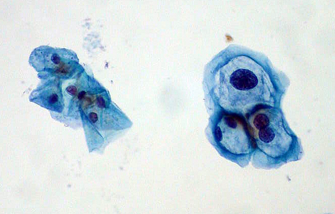 File:ThinPrep Pap smear HPV.jpeg