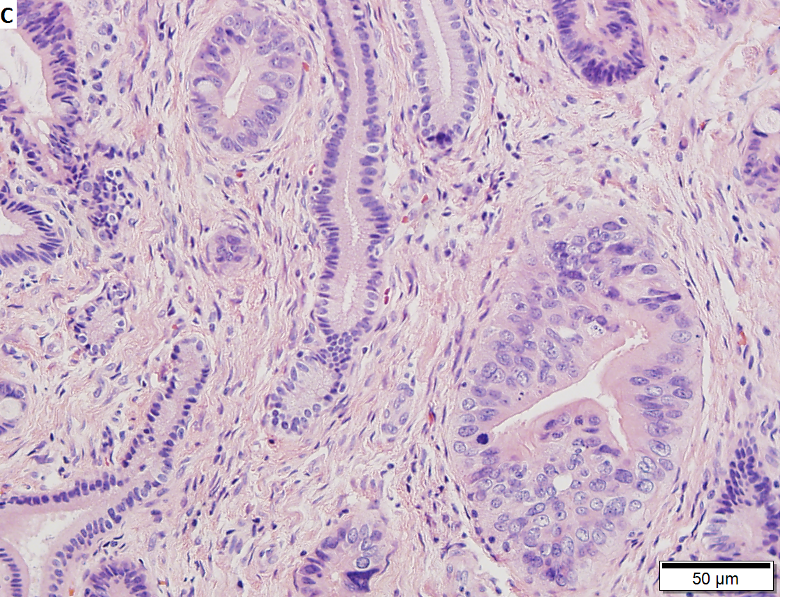 Moderately differentiated adenocarcinoma of gallbladder