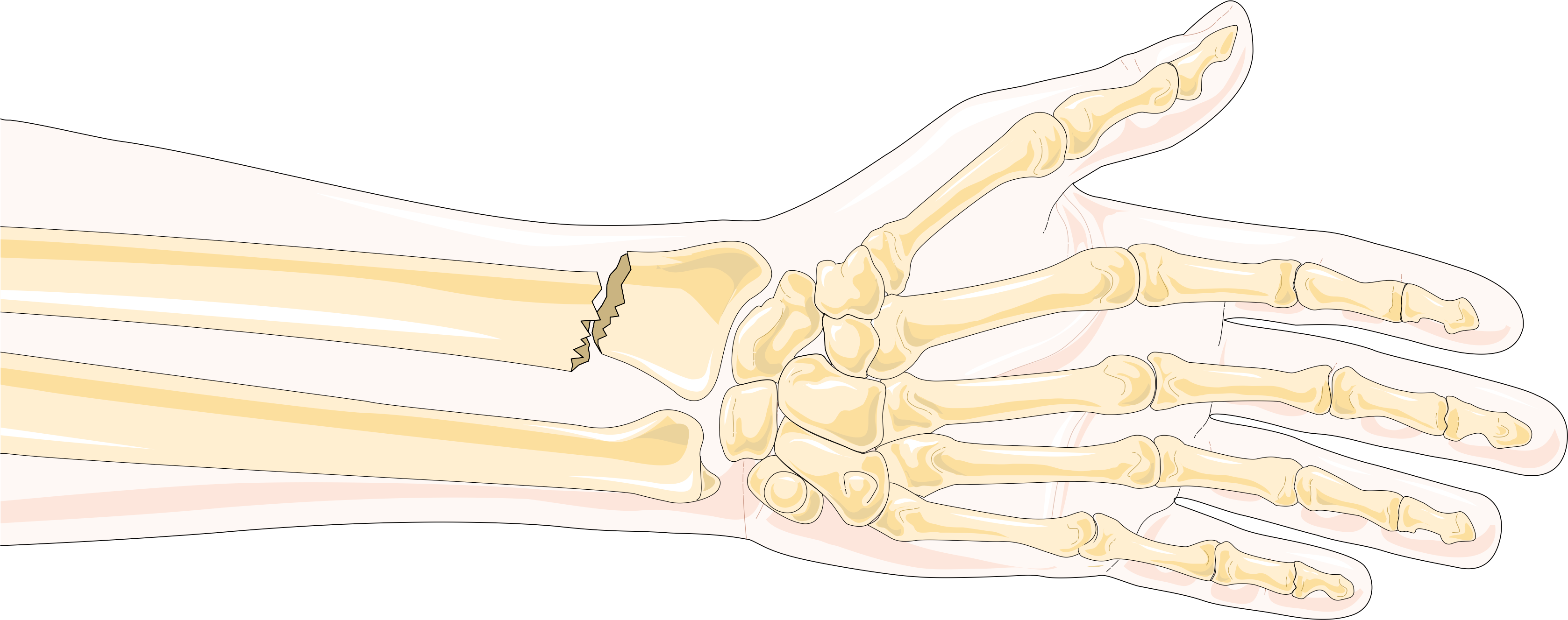 Сколько срастаются лучевые кости на руке
