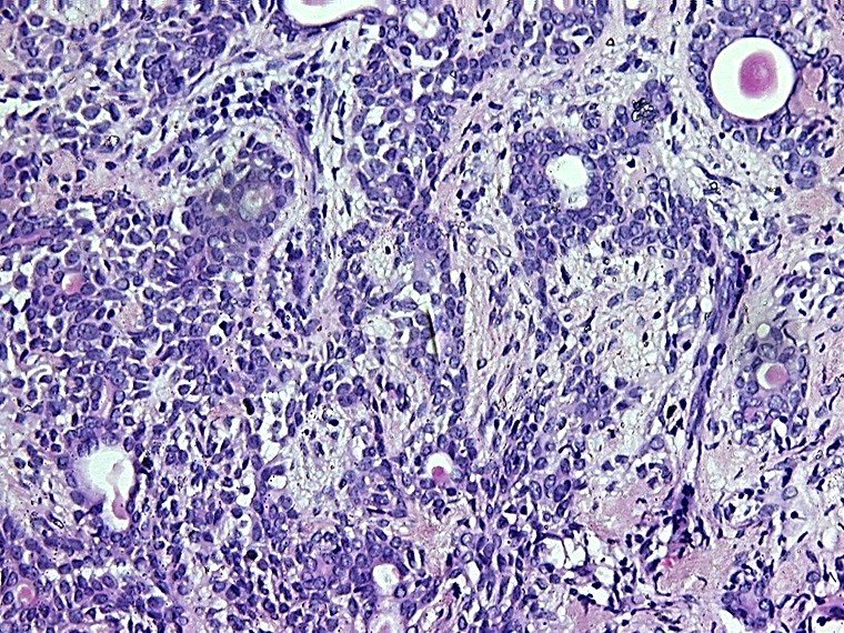 pleomorphic adenoma pathology