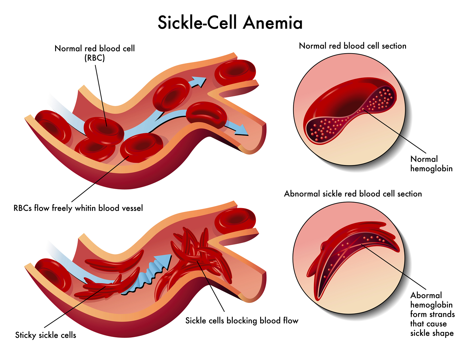 anemia 8 hemoglobina