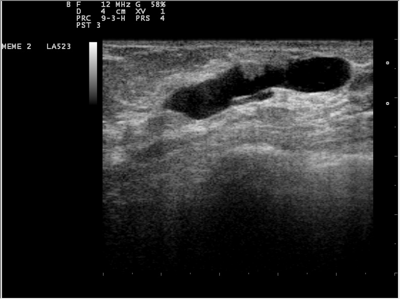 File:Ultrasound 12070I6 intraductal papilloma nevit.jpg