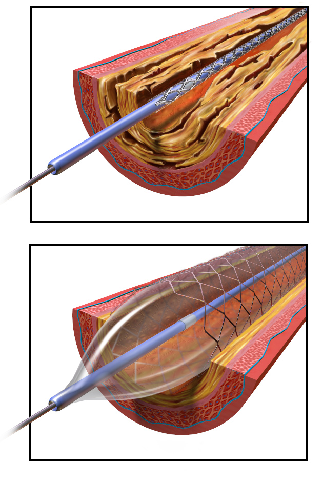 File Angioplasty  Balloon  Inflated with Stent png 