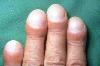 Clubbing of the fingers in idiopathic pulmonary fibrosis