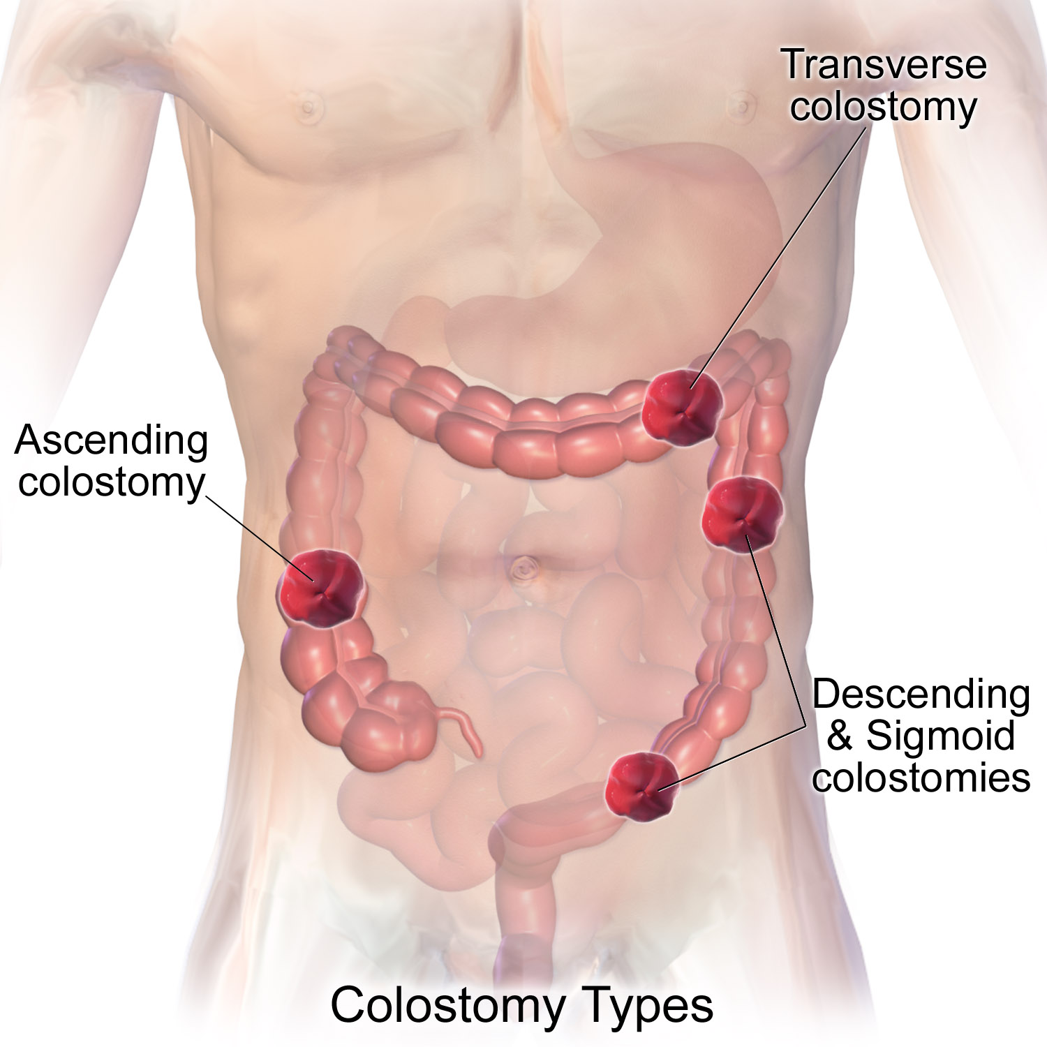 The Main Differences Between Ileostomy vs Colostomy Bag