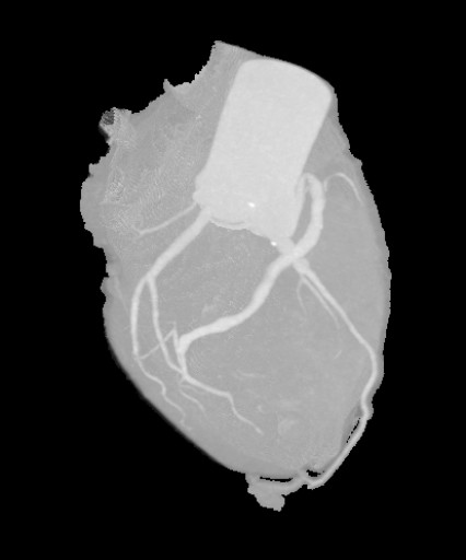 File:Coronaraneursymen bei Kawasaki-Syndrom - CT - Rekonstruktion - MIP - 013.jpg