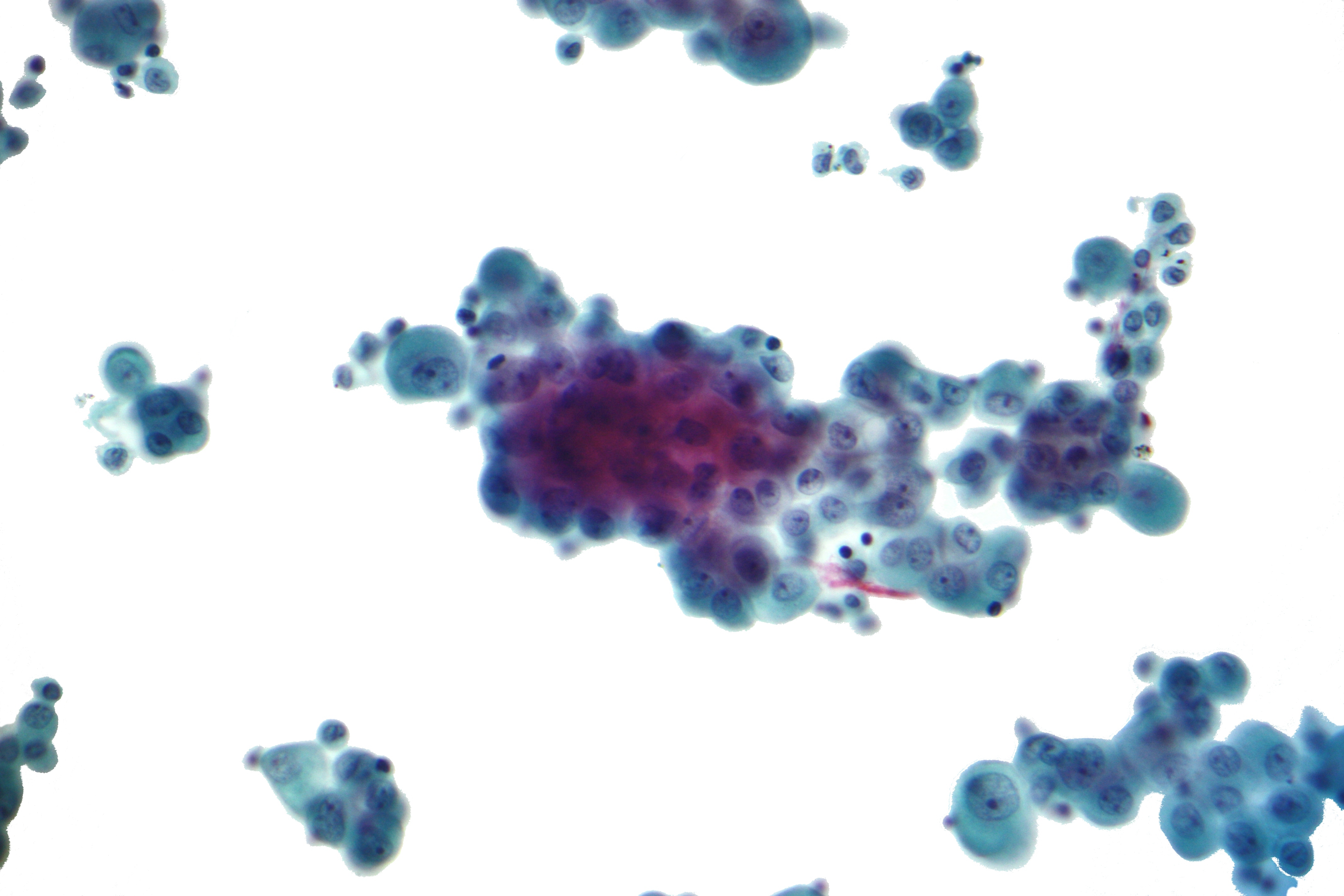 Peritoneal Mesothelioma Wikipedia