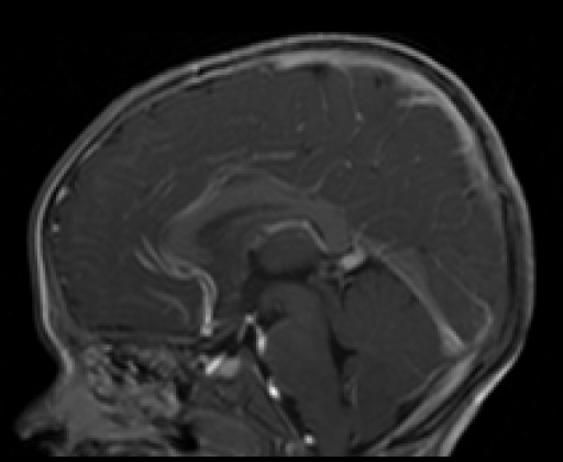 File:Orbitadysplasie bei Neurofibromatose Typ 1 - MRT - T1 sagittal mit KM - 018.jpg