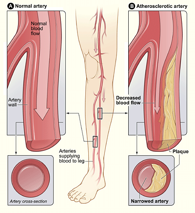 Peripheral Arterial Disease can cause pain in legs when walking