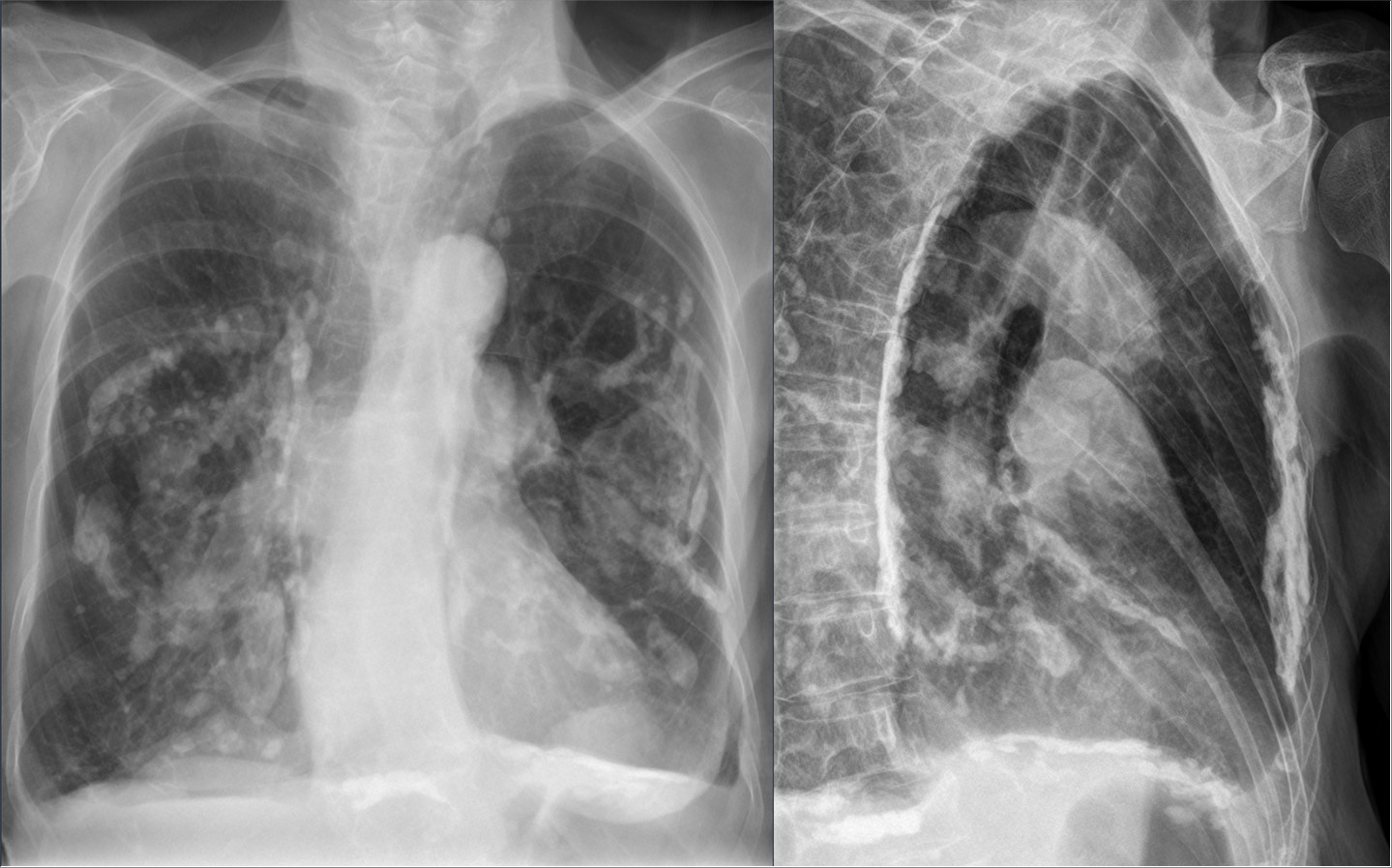 what is fev1 in copd