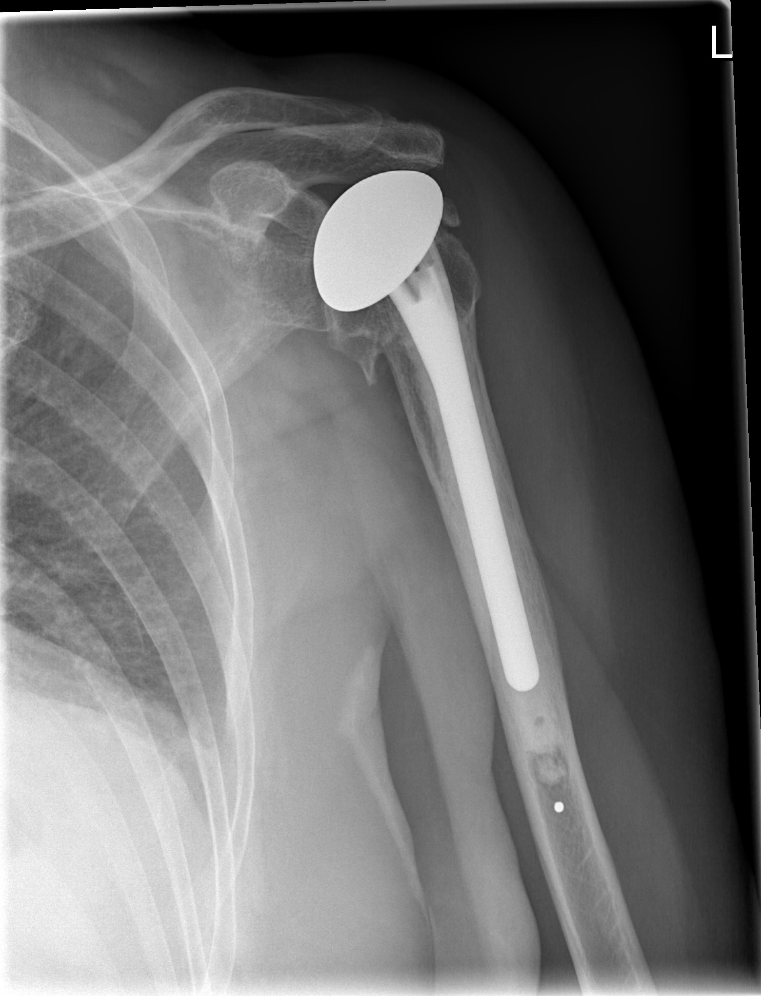 SHOULDER REPLACEMENT SURGERY TO FIX A ROTATOR CUFF TEAR - IS IT REQUIRED?
