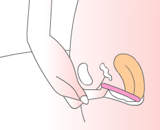 To remove a bell-shaped cup, the seal is broken by running a finger cup the side of the menstrual cup, or pinching the base of the vessel. The cup is then slowly and gently removed, shifting the menstrual cup from side to side.[36]