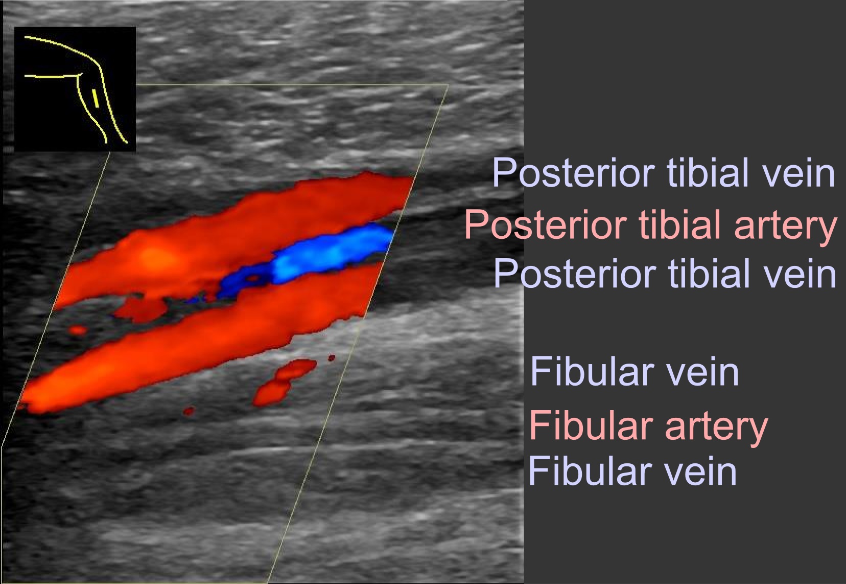 File:Ultrasonography of thrombosis of the fibular veins, coronal