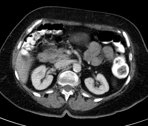 File:Bouveret-Syndrom case 001 - CT - axial - 023.jpg