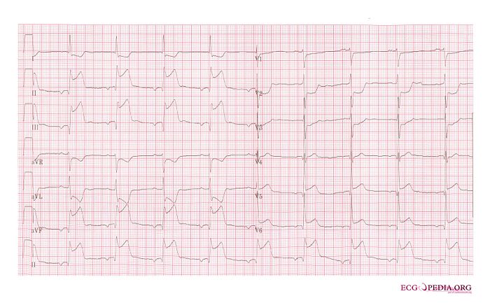 File:De-AMI inferior 2 (CardioNetworks ECGpedia).jpg