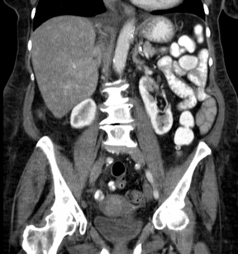 File:Hufeisenniere 06 - CT - coronar - 020.jpg