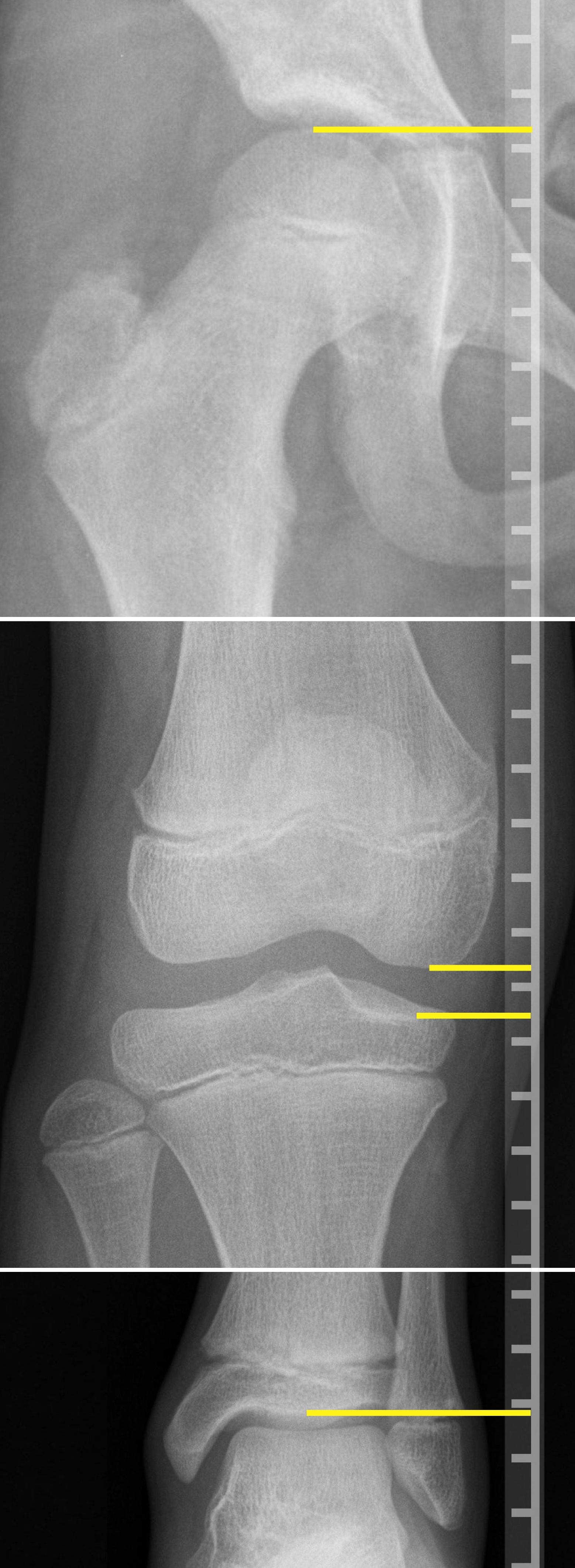 File:Leg length measurement on X-ray.jpg - Wikipedia