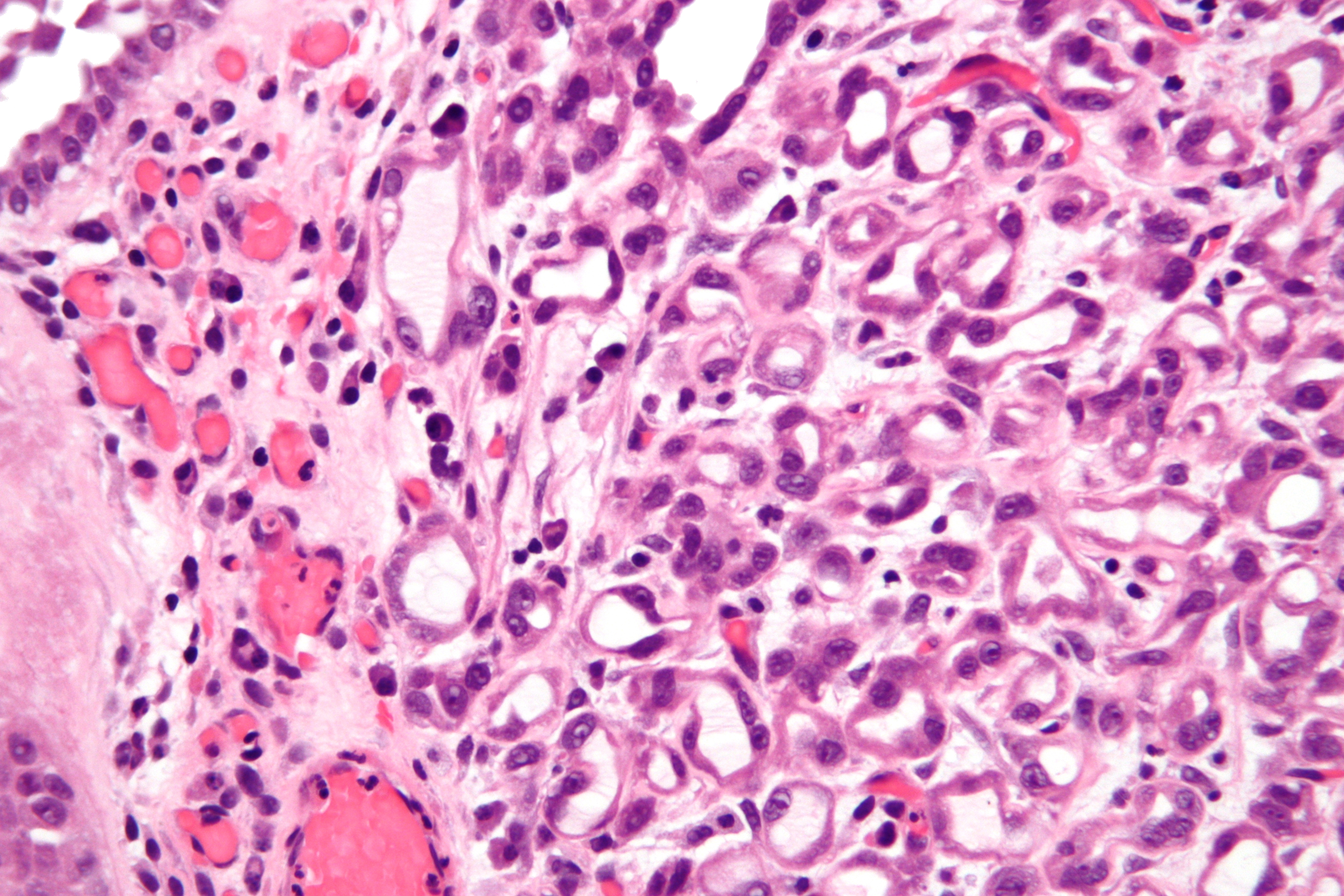 prostatic adenoma pathology outlines