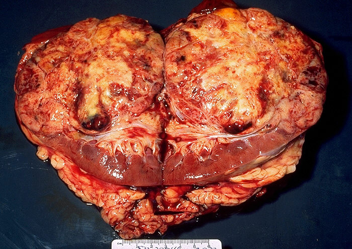 Renal cell carcinoma, gross pathology of bisected kidney 20G0029 lores