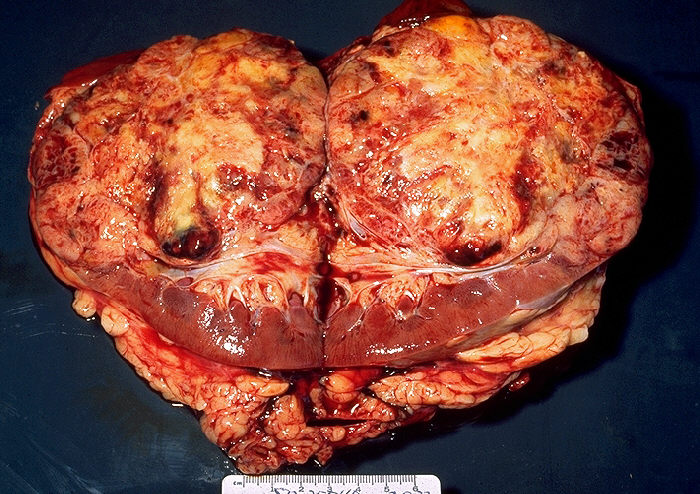 File:Renal cell carcinoma, gross pathology of bisected kidney 20G0029 lores.jpg