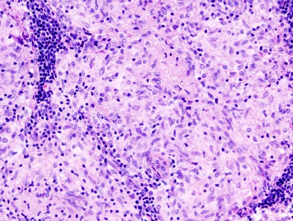 File:Sarcoidosis (3) lymph node biopsy.jpg