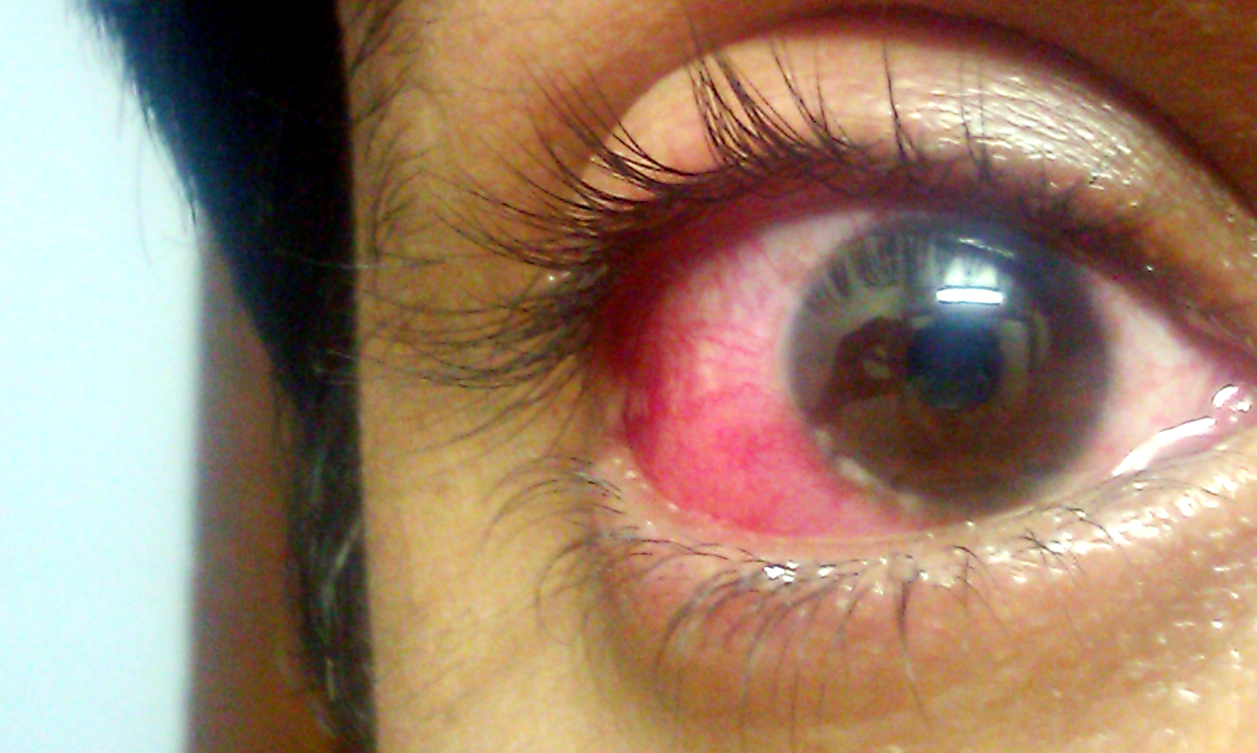 viral keratoconjunctivitis