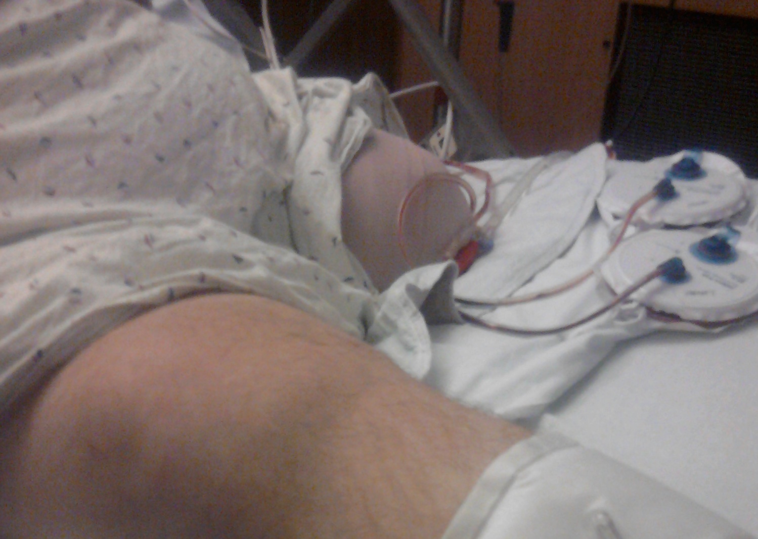 https://upload.wikimedia.org/wikipedia/commons/8/8a/2nd_day_post_op_after_amputation_of_left_leg_due_to_liposarcoma.jpg