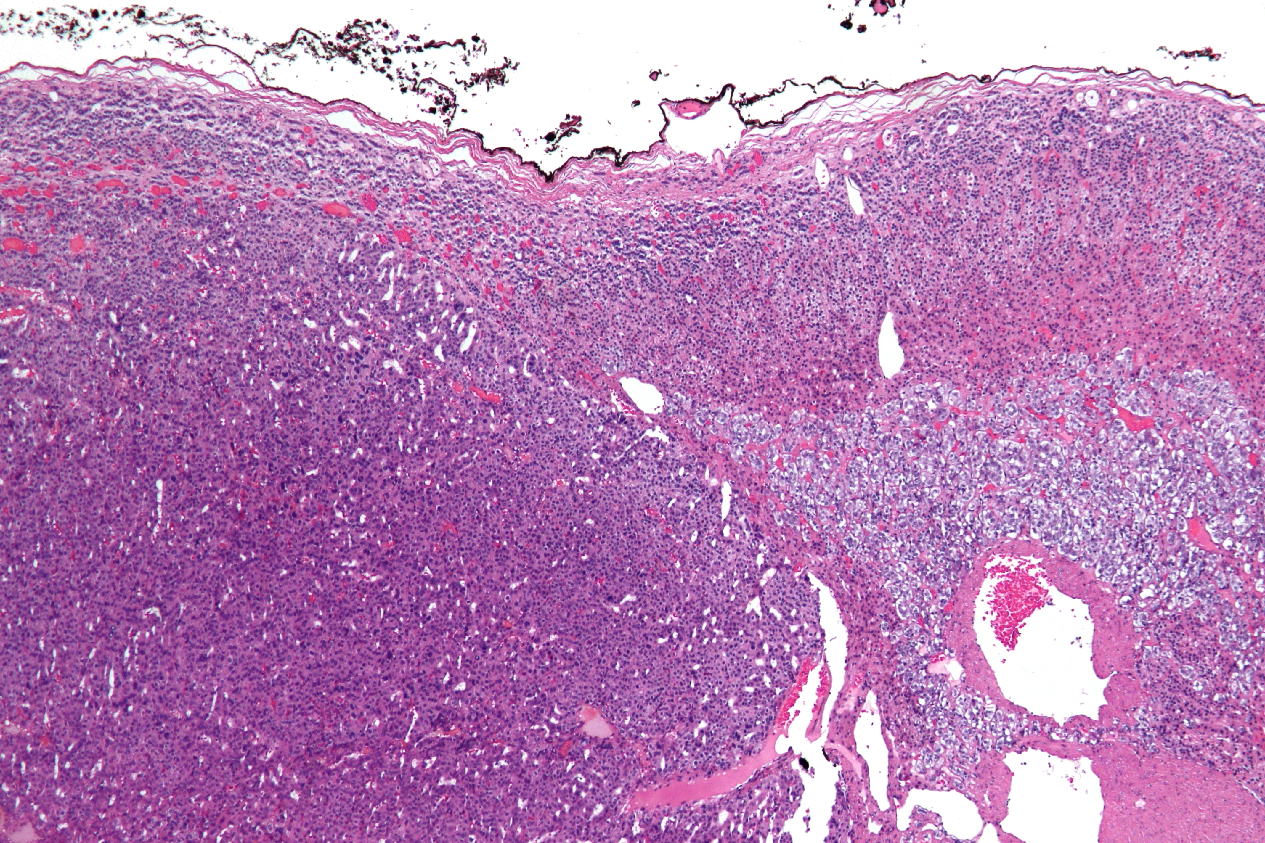 Micrografía de un carcinoma de la corteza suprarrenal