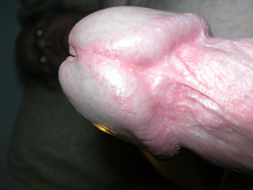 blister on penile shaft pictures #11