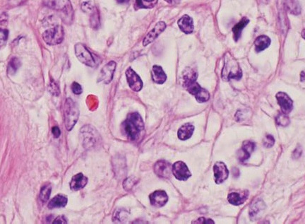 Histopathology of renal clear cell carcinoma