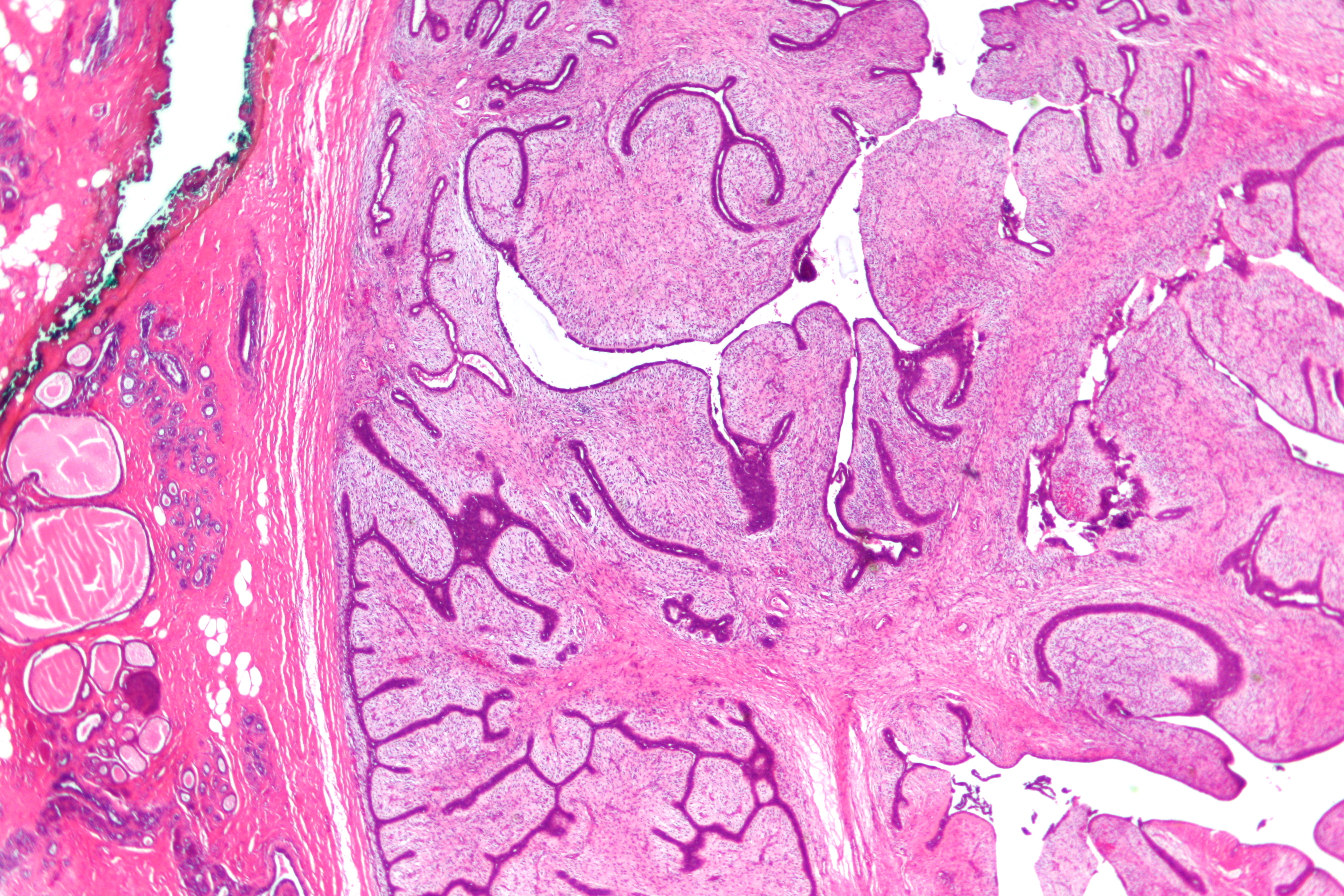 Papiloma ductal mamario. Papiloma ductal de seno, Que es papiloma intraductal de mama