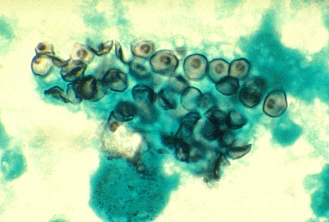 File:Pneumocystis carinii in smear from BAL 01ee046 lores.jpg