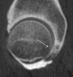 Sagittal CT-arthrography showing posteroinferior chondral injury.[1]