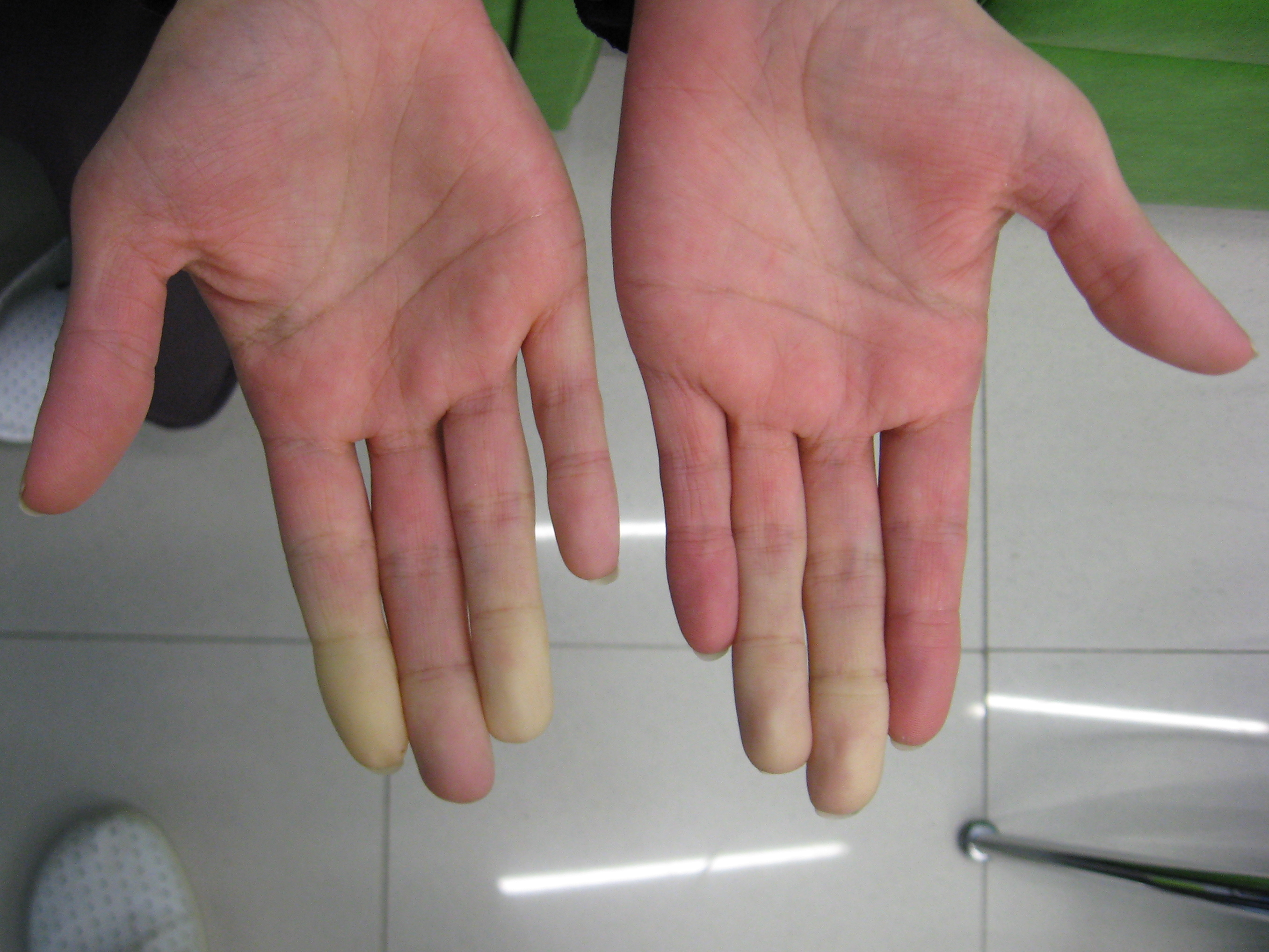 file-secondary-raynaud-s-in-sj-gren-s-syndrome-1-jpg-wikimedia-commons