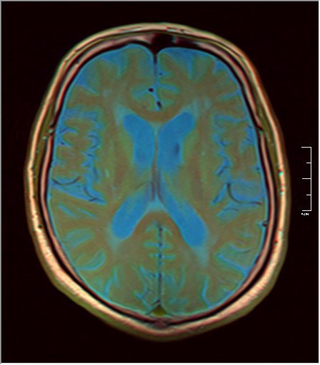 File:Brain MRI 0259 08.jpg