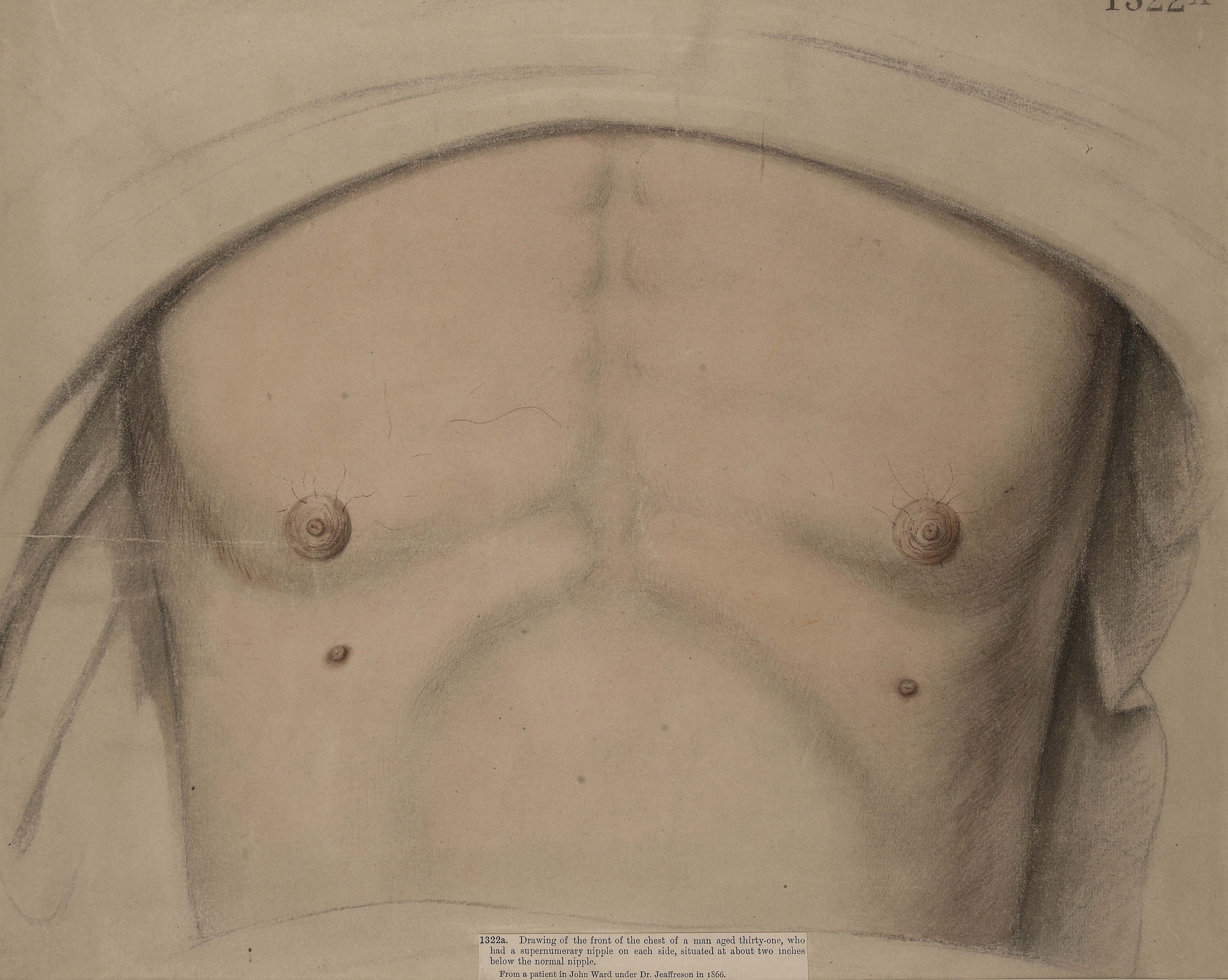 https://upload.wikimedia.org/wikipedia/commons/8/8d/Man_with_supernumerary_nipples_Wellcome_L0061246.jpg