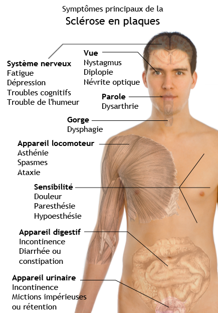 Symptômes principaux de la sclérose en plaques