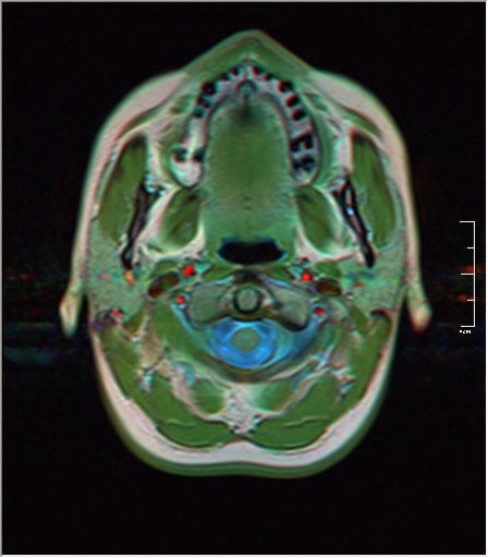 File:Brain MRI 0053 20.jpg