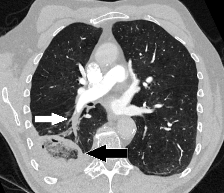 439px x 377px - Pulmonary Embolism: The Most Up-to-Date Encyclopedia, News, Review &  Research