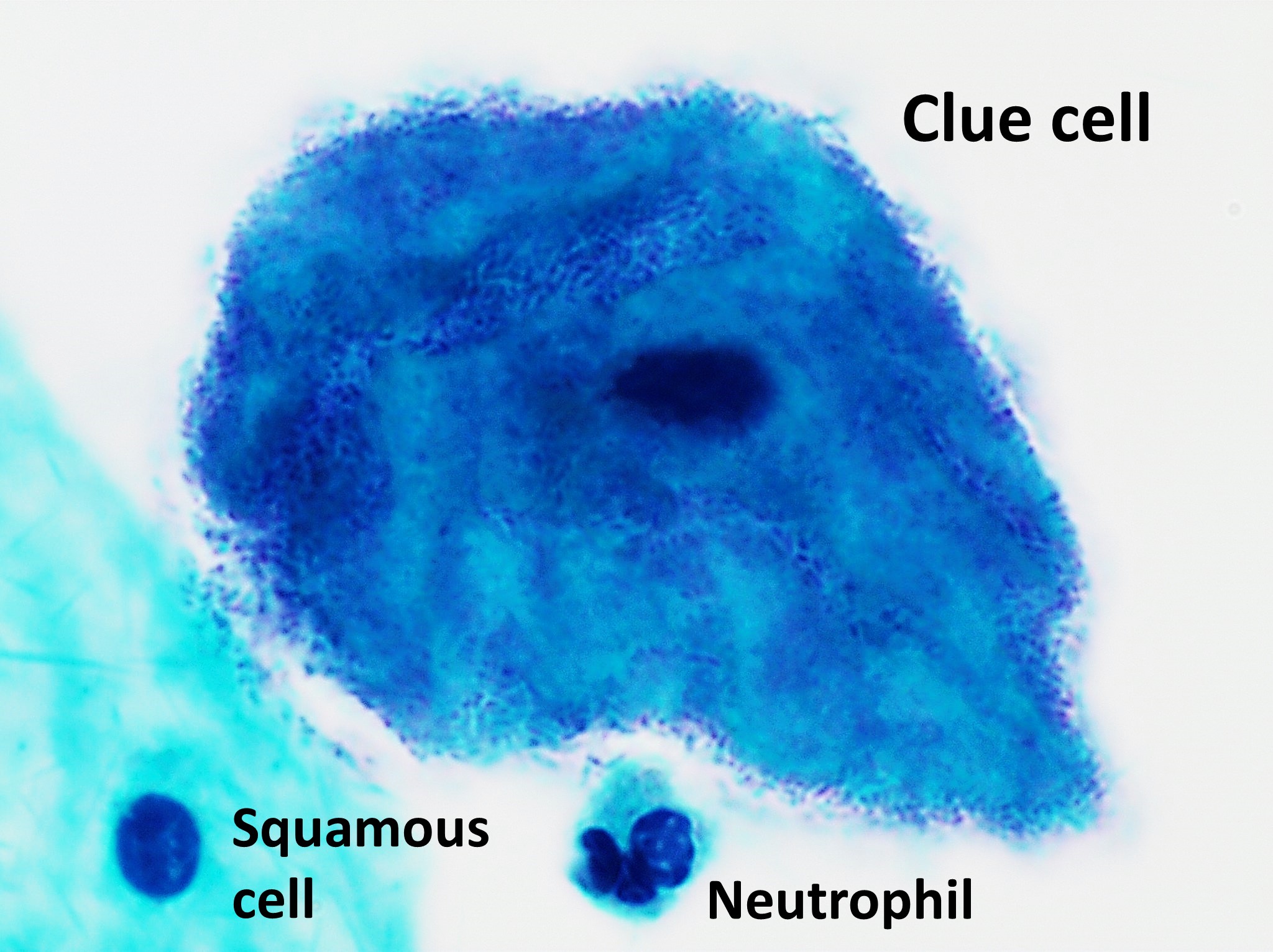 trichomonads and clue cells