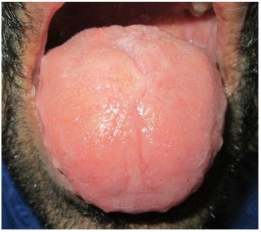 Macroglossia with crenations along the margins and loss of papillae on dorsum surface of the tongue